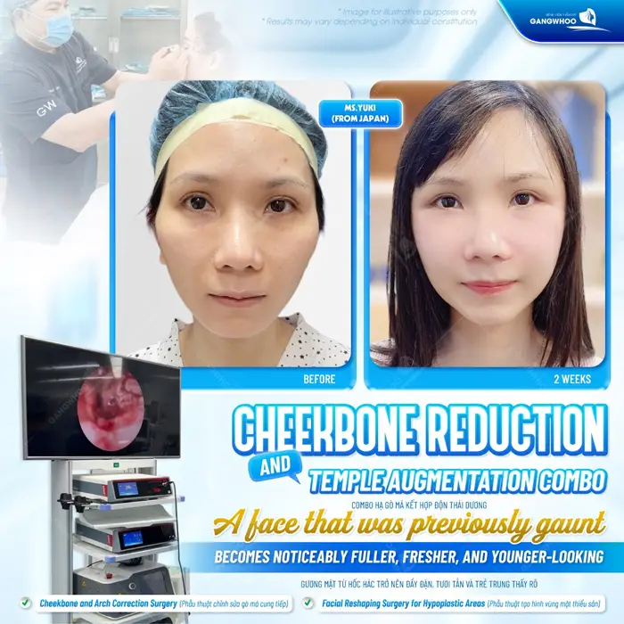 Hạ gò má kết hợp độn thái đương đường nét gương mặt thêm hài hòa, cân đối và trẻ trung 