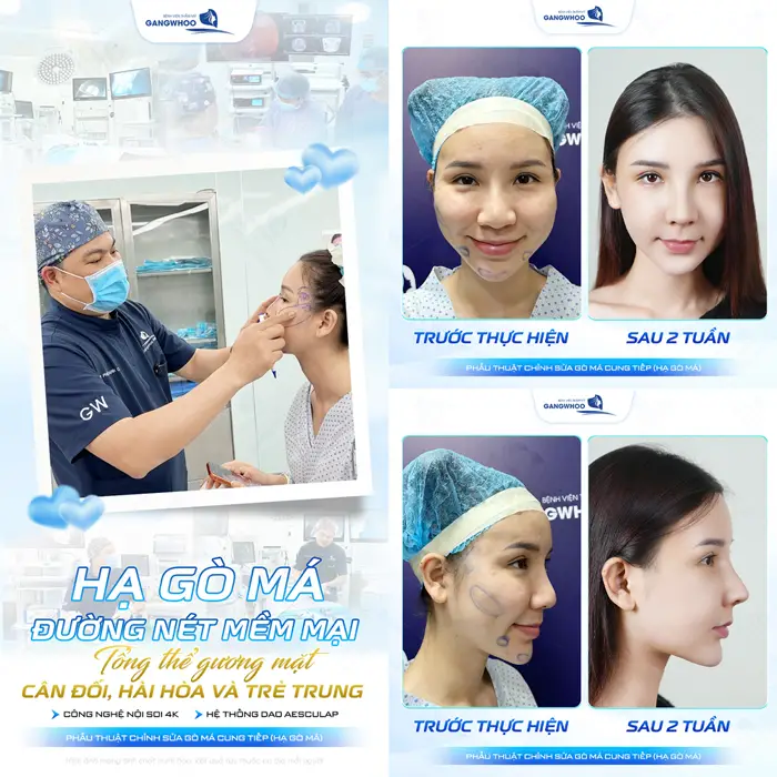 Hạ gò má đường nét mềm mại tổng thể gương mặt cân đối, hài hòa và đẹp trẻ trung