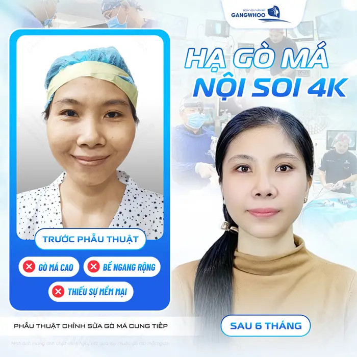 Hạ gò má nội soi cải thiện đường nét gương mặt diện mạo thêm hài hòa, thanh thoát hơn thấy rõ