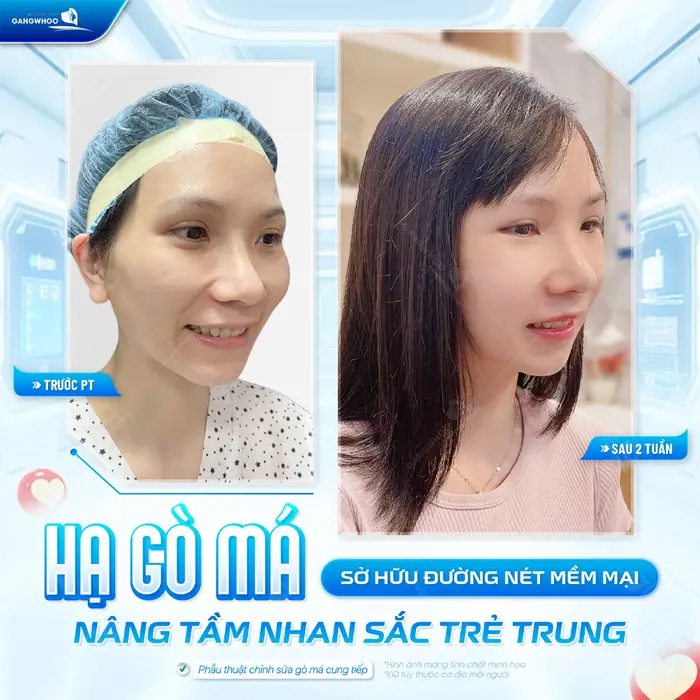 Hạ gò má sở hữu đường nét mềm mại, nâng tầm nhan sắc đẹp trẻ trung và thanh thoát