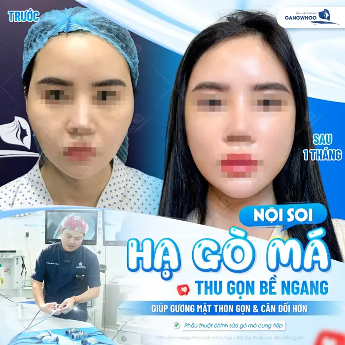 Hạ gò má ứng dụng công nghệ nội soi thu gọn bề ngang giúp gương mặt thon gọn và cân đối hơn