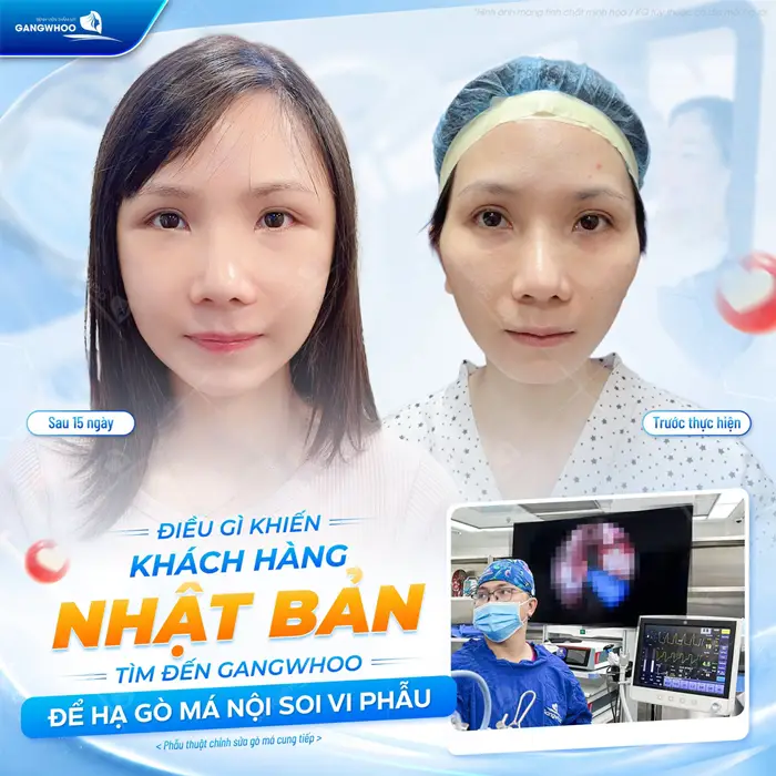 Hạ gò má nội soi 4K sau 15 ngày gương mặt đẹp cân đối, hài hòa đường nét thêm thanh thoát và rạng rỡ hơn