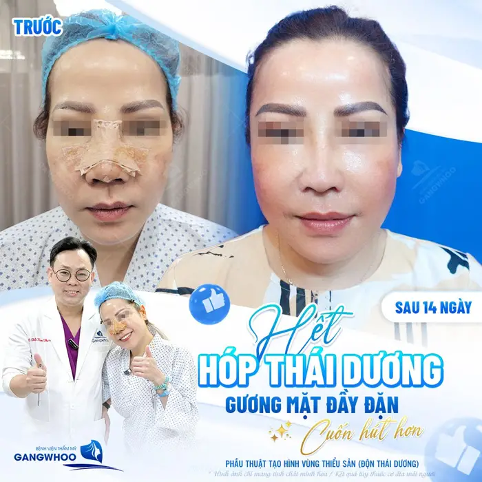 Hết hóp thái đương gương mặt đầy đặn cuốn hút hơn sau 14 ngày đã hoàn toàn khác biệt