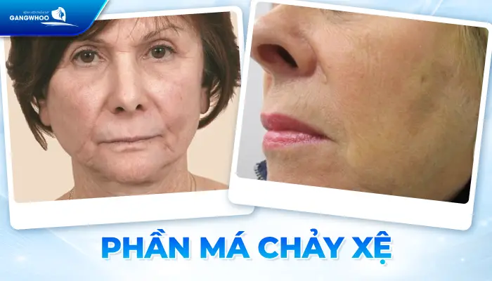 6 Tác Hại Của Hạ Gò Má Sau Phẫu Thuật Nên Cẩn Thận