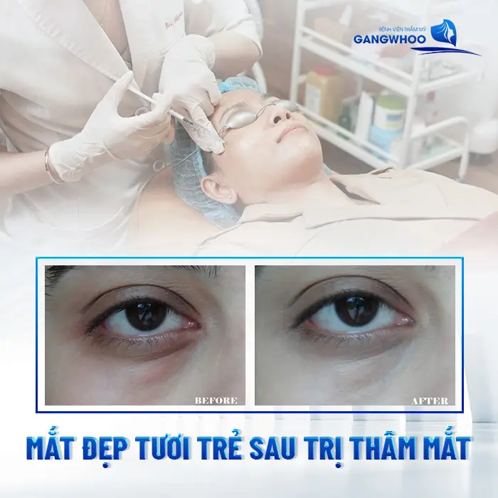 Điều Trị Thâm Mắt: Khôi Phục Đôi Mắt Đẹp Rạng Rỡ, Sáng Ngời 18 Điều Trị Thâm Mắt: Khôi Phục Đôi Mắt Đẹp Rạng Rỡ, Sáng Ngời