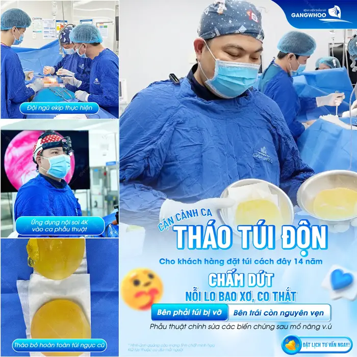 Cận cảnh ca tháo túi độn cho khách hàng đặt túi cách đây 14 năm tại bệnh viện thẩm mỹ Gangwhoo 