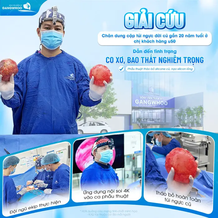 Giải cứu cơ xơ, bao thắt nghiêm trọng cho chị khách hàng U50 với cặp túi ngực cũ gần 20 năm