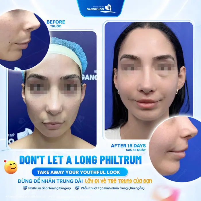 Thu ngắn nhân trung dài lấy lại vẻ trẻ trung cho gương mặt, cải thiện nhan sắc và thăng hạng diện mạo hơn thấy rõ