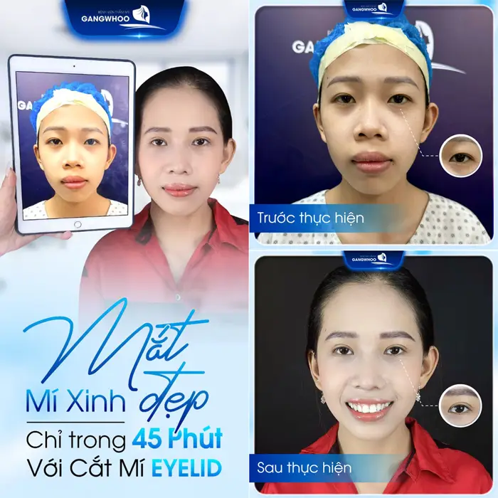 Top 3 Địa Chỉ Cắt Mí Trả Góp Giá Rẻ Tại TPHCM 32 Mắt đẹp mí xinh nhanh chóng chỉ sau 45 phút cắt mí Eyelid ứng dụng công nghệ cao