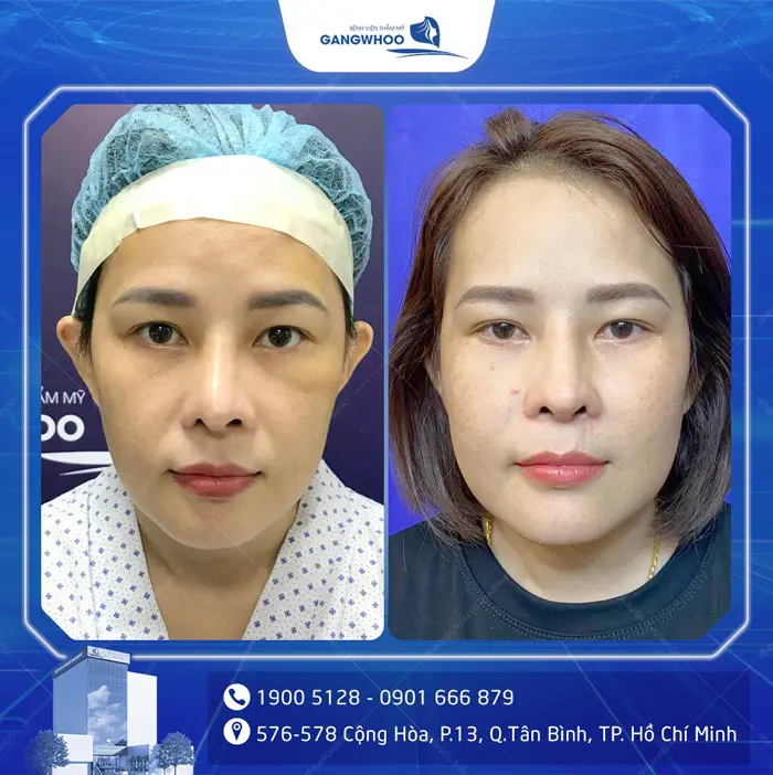 Nâng Mũi Sụn Sườn Tự Thân Nội Soi Vi Phẫu Là Gì? Ai Nên Thực Hiện 20 khách hàng nâng mũi sụn sườn