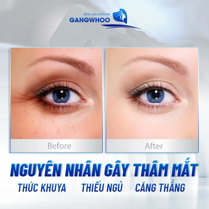 Điều Trị Thâm Mắt: Khôi Phục Đôi Mắt Đẹp Rạng Rỡ, Sáng Ngời 15 Điều Trị Thâm Mắt: Khôi Phục Đôi Mắt Đẹp Rạng Rỡ, Sáng Ngời