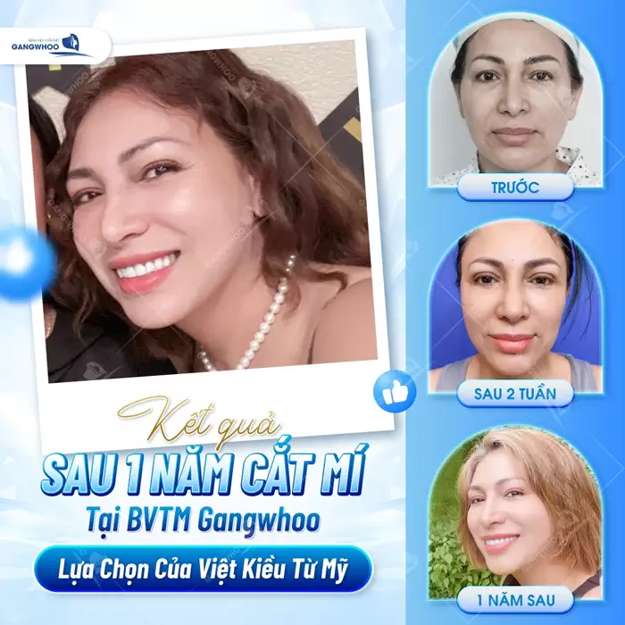 Cắt mí sử dụng dao Harmonic mắt đẹp tự nhiên và bền lâu 