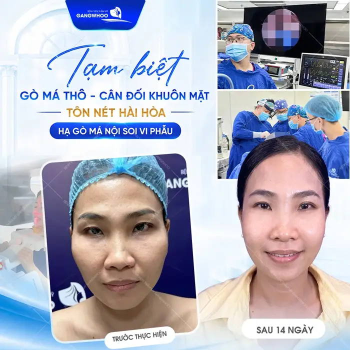 Tạm biệt gò má thô, cân đối khuôn mặt tôn nét đẹp hài hòa sau hạ gò má nội soi vi phẫu 