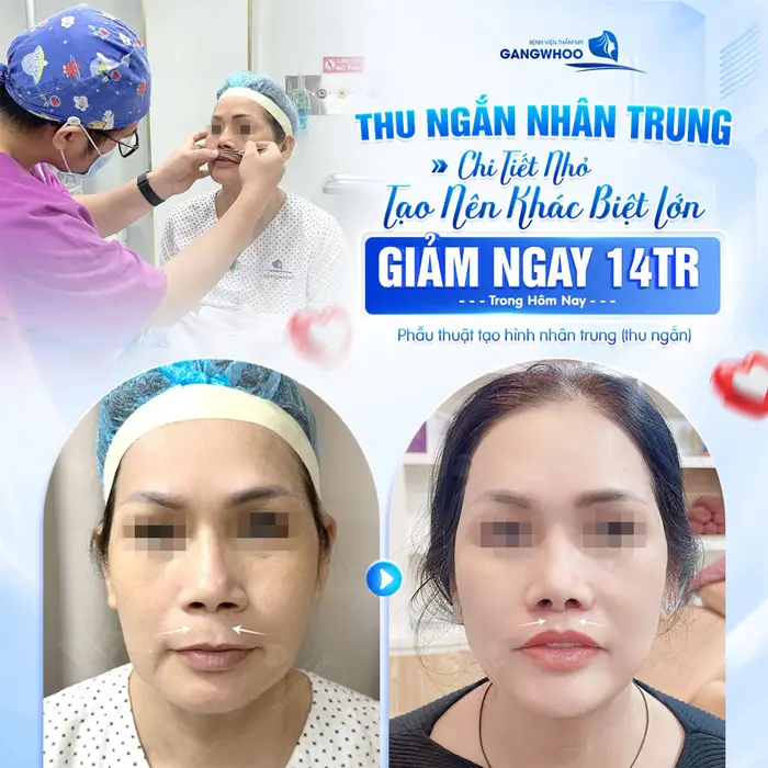 Thu Ngắn Nhân Trung Là Gì? Cắt Ngắn Nhân Trung Giá Bao Nhiêu? 4 Thu ngắn nhân trung chi tiết nhỏ tạo nên sự khác biệt lớn