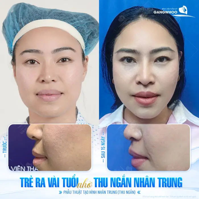 Thu Ngắn Nhân Trung Là Gì? Cắt Ngắn Nhân Trung Giá Bao Nhiêu? 2 Trẻ ra vài tuổi nhờ thu ngắn nhân trung gương mặt đẹp hơn, tự tin hơn