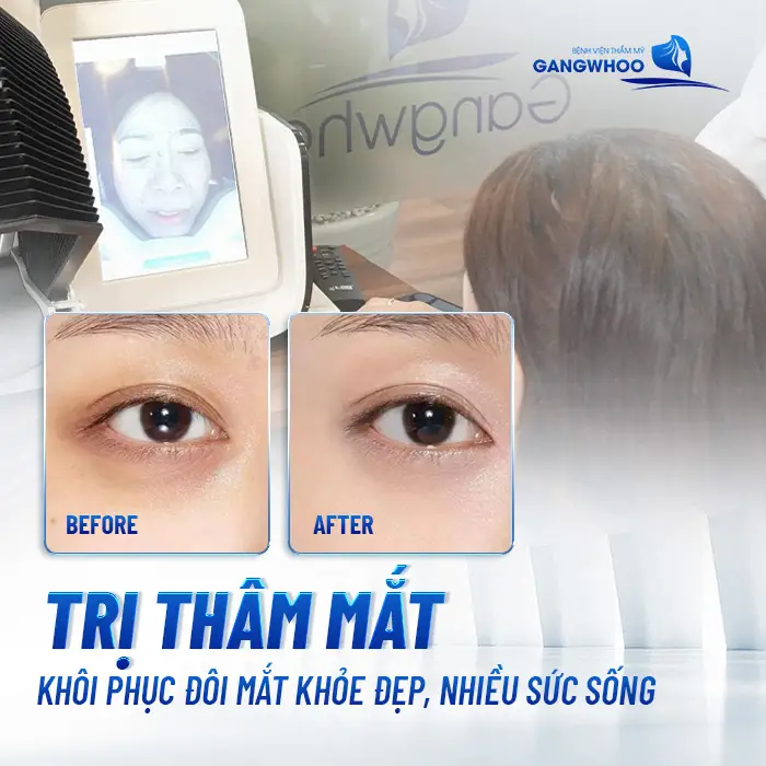 Điều Trị Thâm Mắt: Khôi Phục Đôi Mắt Đẹp Rạng Rỡ, Sáng Ngời 16 Điều Trị Thâm Mắt: Khôi Phục Đôi Mắt Đẹp Rạng Rỡ, Sáng Ngời