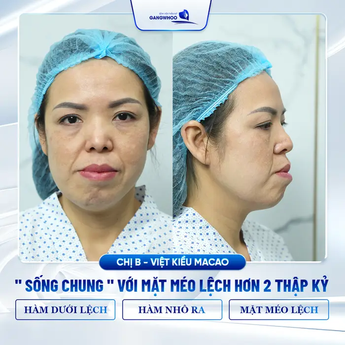 Hành Trình Khắc Phục Hàm Lệch Sau Tai Nạn Của Chị.B Từ Macao