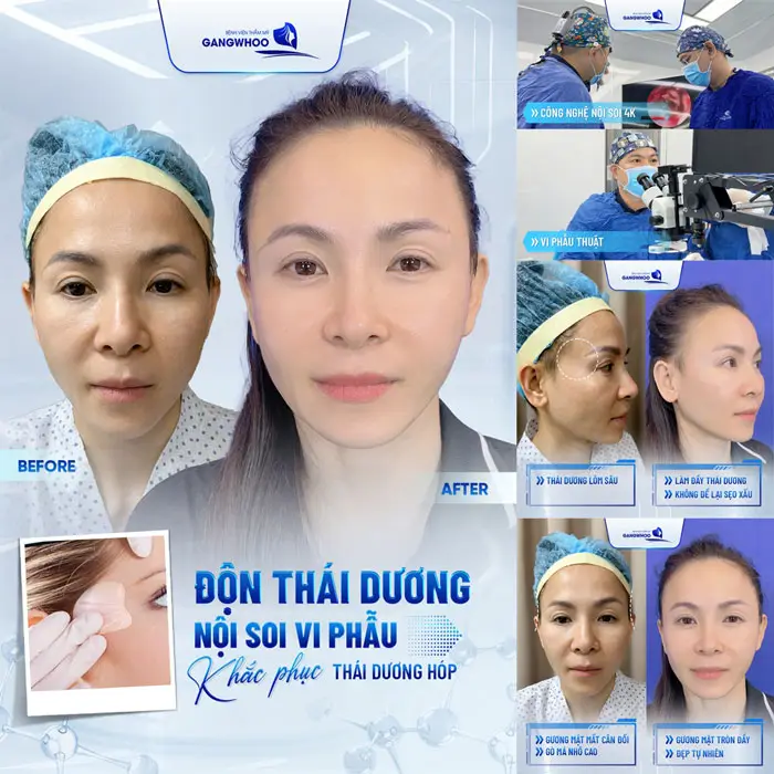 Độn Thái Dương Sở Hữu Gương Mặt Thanh Tú Đầy Sức Sống 4 Độn thái dương nội soi vi phẫu khắc phục hiệu quả cho người bị hóp