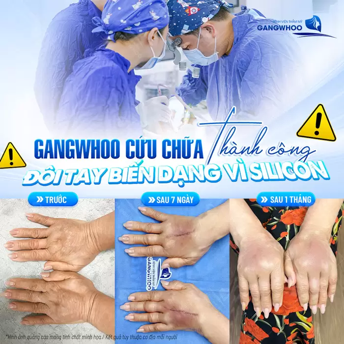 Silicon Lỏng Là Gì? Có Nên Tiêm Silicon Lỏng Để Làm Đẹp Không? 9 Gangwhoo cứu chữa thành công đôi tay biến dạng vì silicon cho khách hàng