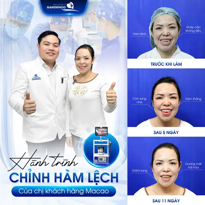 Hành Trình Khắc Phục Hàm Lệch Sau Tai Nạn Của Chị.B Từ Macao