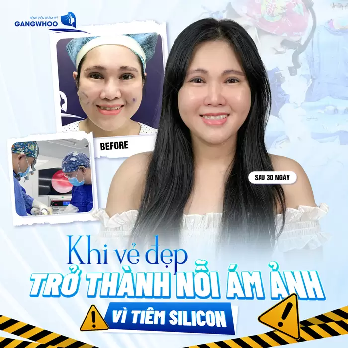 Silicon Lỏng Là Gì? Có Nên Tiêm Silicon Lỏng Để Làm Đẹp Không? 2 Tiêm silicon dỏm khách hàng phải hứng chịu hậu quả mặt biến dạng và nay đã được khắc phục tại Gangwhoo