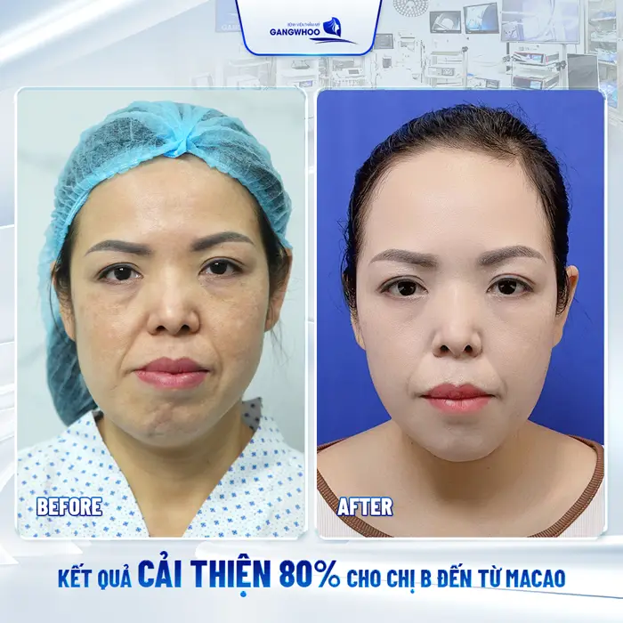 Hành Trình Khắc Phục Hàm Lệch Sau Tai Nạn Của Chị.B Từ Macao