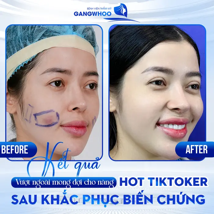 Hot Tiktoker Linh Barbie và Hành Trình Tìm Lại Nhan Sắc Tại BVTM Gangwhoo