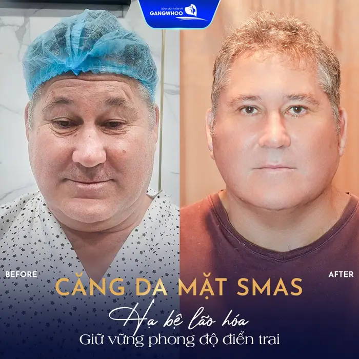 Căng Da Mặt Cho Nam Giải Pháp Cho Gương Mặt Trẻ Trung Phong Độ 18 Căng Da Mặt Cho Nam Giải Pháp Cho Gương Mặt Trẻ Trung Phong Độ