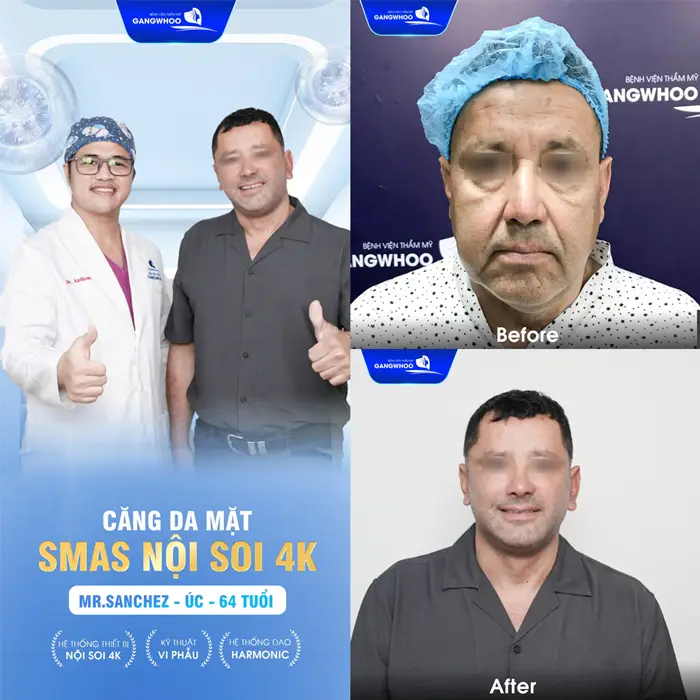 Căng Da Mặt Cho Nam Giải Pháp Cho Gương Mặt Trẻ Trung Phong Độ 20 Căng Da Mặt Cho Nam Giải Pháp Cho Gương Mặt Trẻ Trung Phong Độ