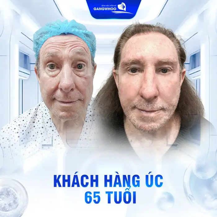 Căng Da Mặt Cho Nam Giải Pháp Cho Gương Mặt Trẻ Trung Phong Độ 19 Căng Da Mặt Cho Nam Giải Pháp Cho Gương Mặt Trẻ Trung Phong Độ