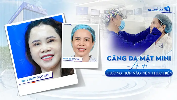 CĂNG DA MẶT (DA THỪA VÙNG MẶT) - Trường Hợp Nào Nên Thực Hiện? 23 Căng Da Mặt Mini Là Gì? Trường Hợp Nào Nên Thực Hiện