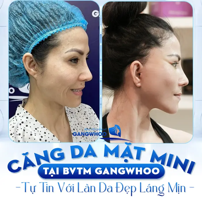 CĂNG DA MẶT (DA THỪA VÙNG MẶT) - Trường Hợp Nào Nên Thực Hiện? 24 cang da mat mini tu tin khoe lan da lang min