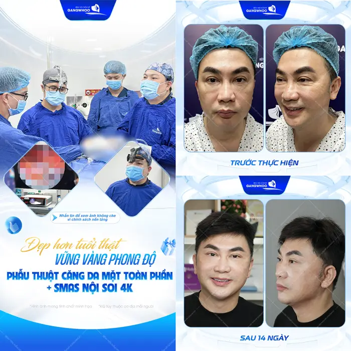 Đẹp hơn tuổi thật vững vàng phong độ sau phẫu thuật căng da mặt Smas nội soi 4K hiện đại 