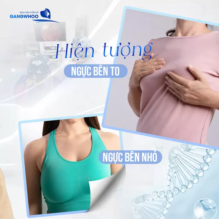 Hiện Tượng Ngực Bên To Bên Nhỏ Là Gì? Cách Khắc Phục Thế Nào