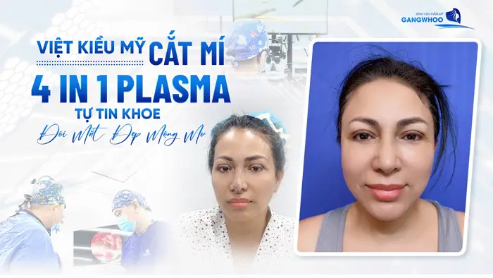 Việt Kiều Mỹ Cắt Mí 4 In 1 Plasma Tự Tin Khoe Đôi Mắt Đẹp Mộng Mơ 7 Việt Kiều Mỹ Cắt Mí 4 In 1 Plasma Tự Tin Khoe Đôi Mắt Đẹp Mộng Mơ