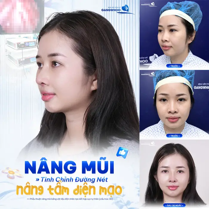 Nâng mũi S Line Là Gì? Khác Gì So Với Nâng Mũi L Line 1 Nâng mũi tinh chỉnh đường nét khuôn mặt nâng tầm diện mạo thêm hài hòa và thanh thoát