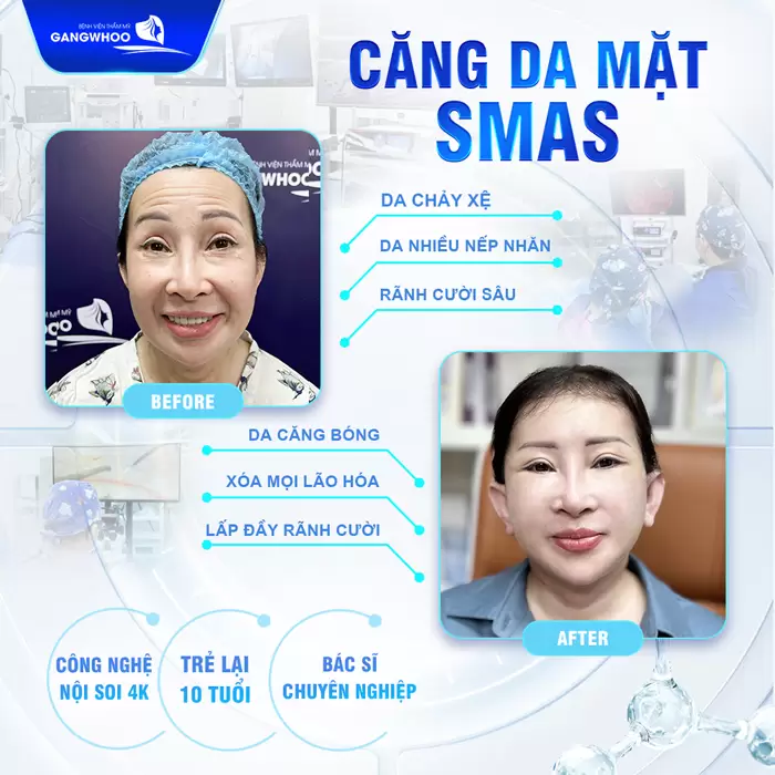 Kéo Fine Scrafting Scissor Công Nghệ Mới Áp Dụng Trong Căng Da Mặt 9 Kéo Fine Scrafting Scissor Công Nghệ Mới Áp Dụng Trong Căng Da Mặt