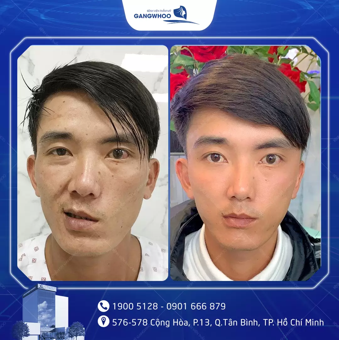 dieu tri liet mat 11