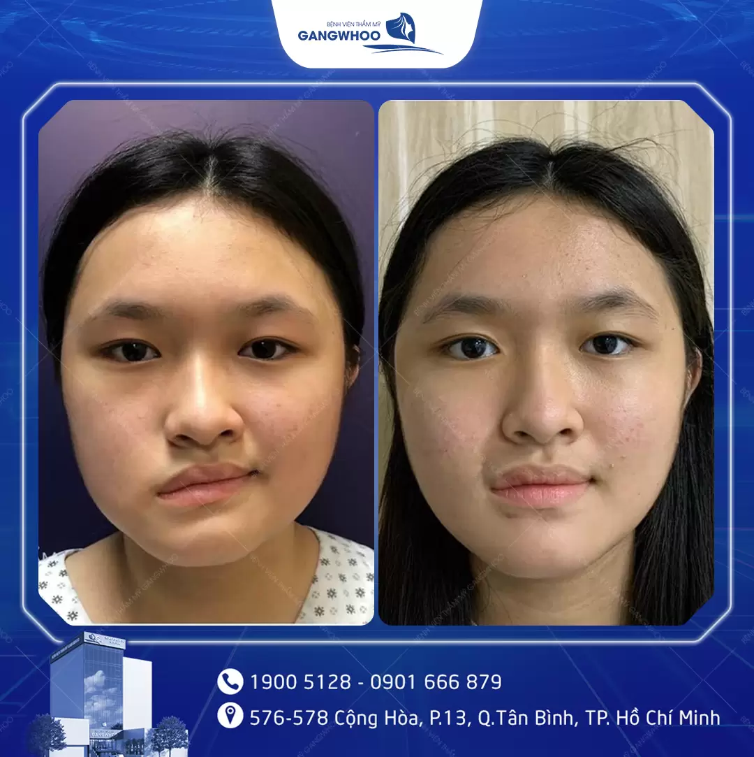 dieu tri liet mat 13