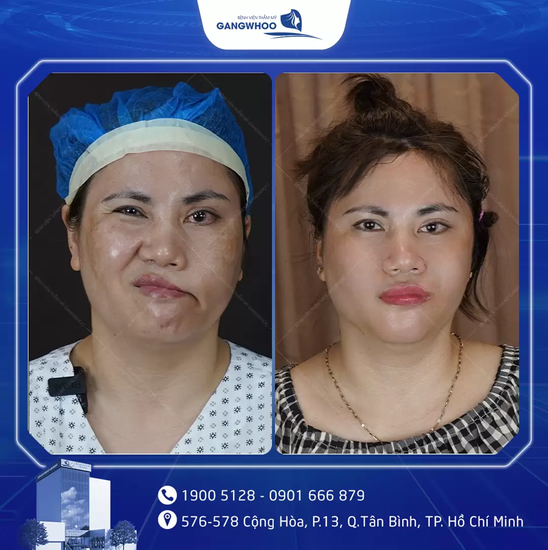 dieu tri liet mat 14