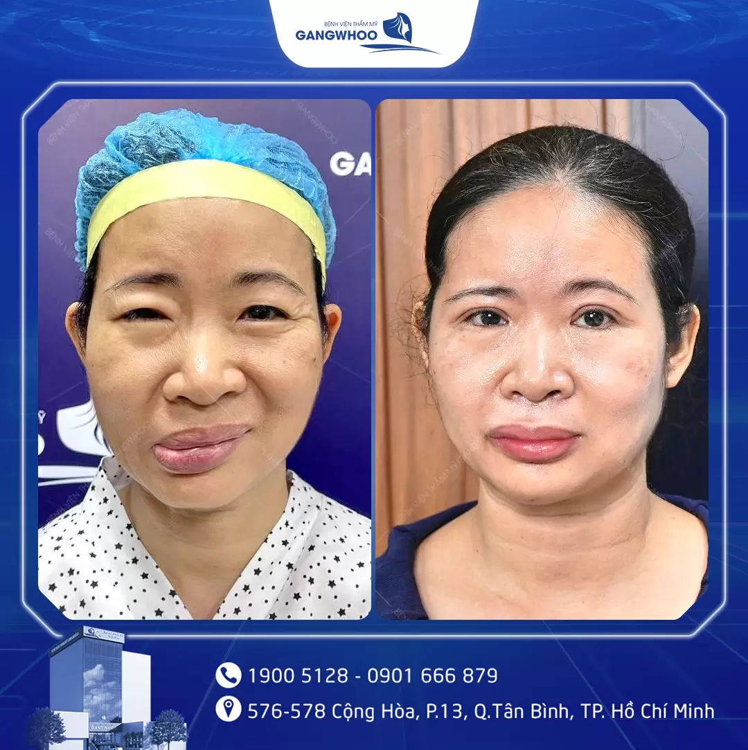 dieu tri liet mat 15