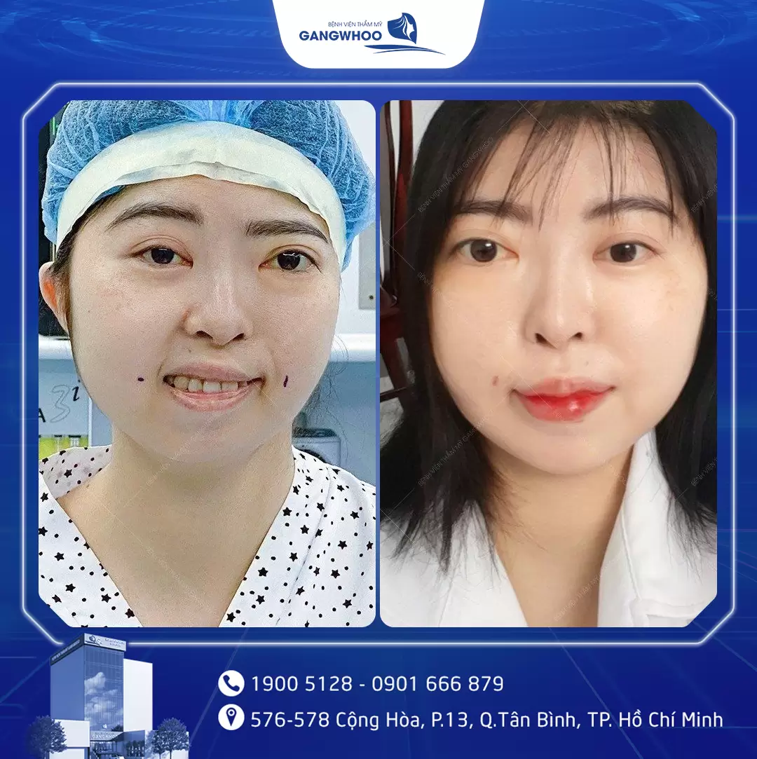 dieu tri liet mat 16