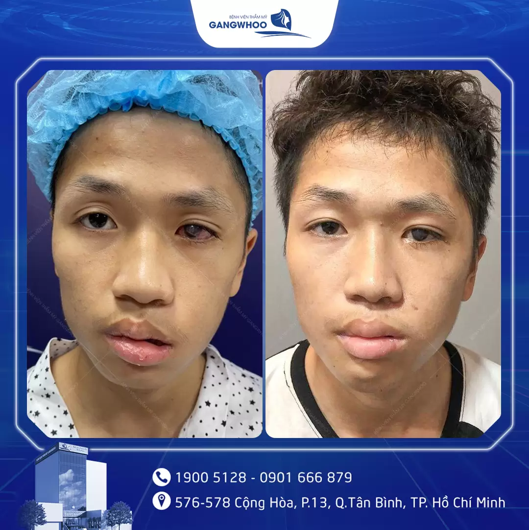 dieu tri liet mat 17