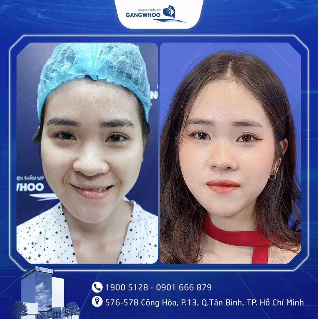 dieu tri liet mat 18