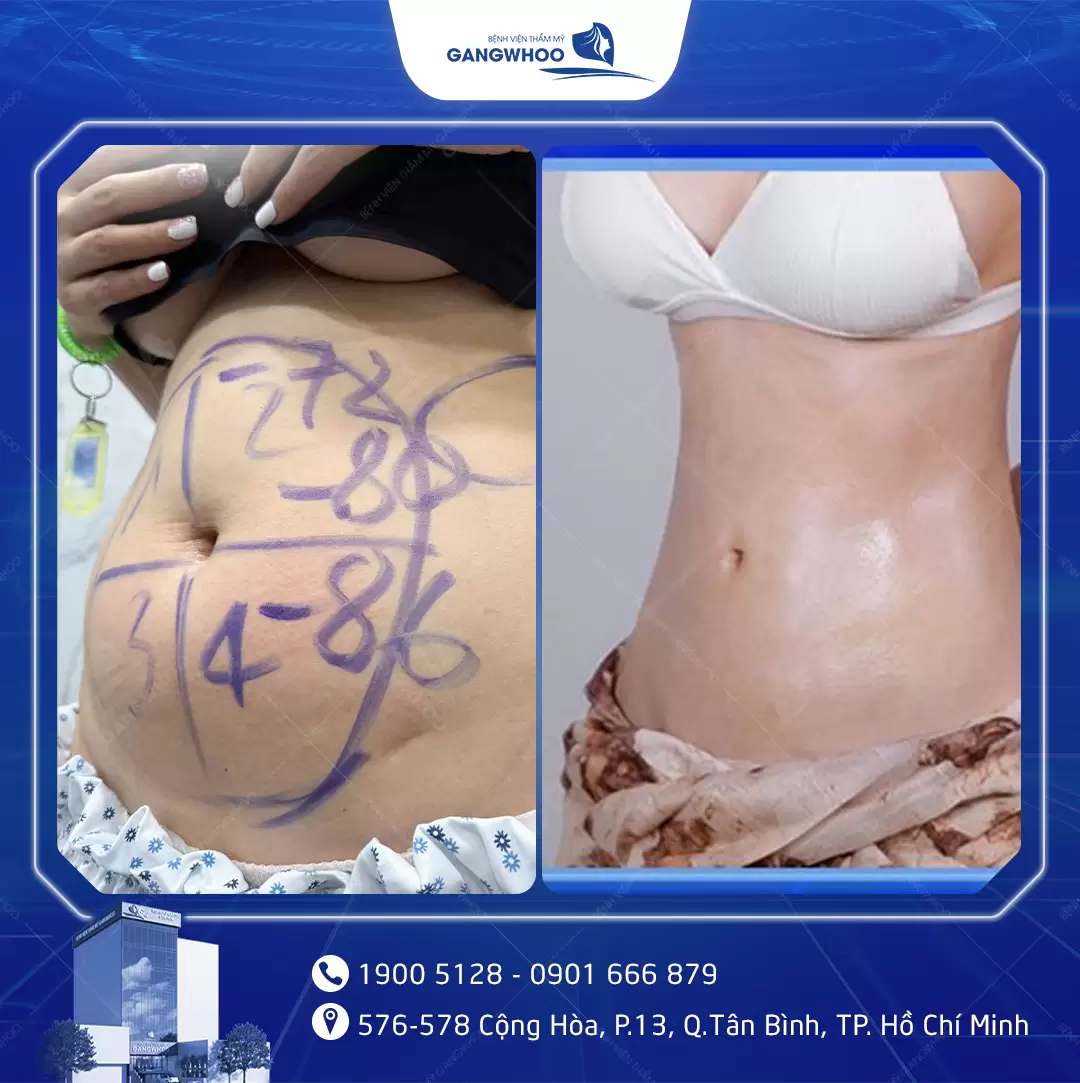 Safe Liposuction Guide for International Clients in Vietnam 10 hut mo bung 24