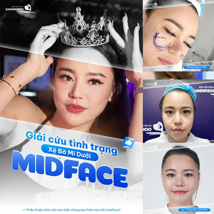 Giải cứu tình trạng xệ bờ mi dưới bằng Midface cải thiện diện mạo nâng tầm nhan sắc trẻ đẹp đầy bất ngờ