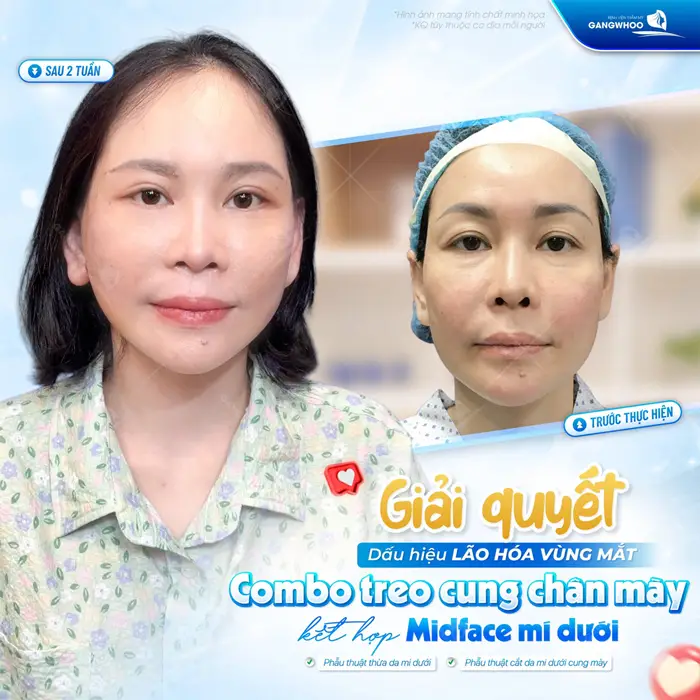 Giải quyết dấu hiệu lão hóa vùng mắt sau khi thực hiện combo treo cung chân mày kết hợp Midface mí dưới