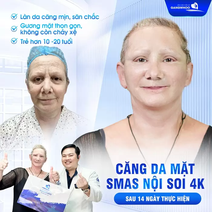 Phẫu Thuật Midface "Hack Tuổi" Tầng Mặt Giữa Xu Hướng Làm Đẹp Mới 12 Phẫu Thuật Midface "Hack Tuổi" Tầng Mặt Giữa Xu Hướng Làm Đẹp Mới
