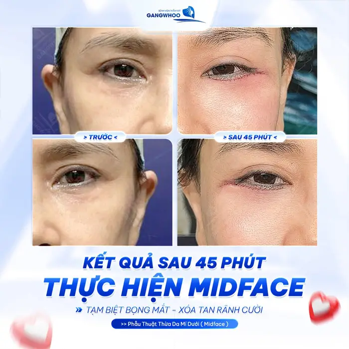 Phẫu Thuật Nâng Tầng Mặt Giữa (Midface Lift) Cải Thiện Bọng Mắt, Rãnh Lệ Và Má Chảy Xệ 12 Kết quả sau 45 phút thực hiện Midface tạm biệt bọng mắt xóa tan rãnh cười hiệu quả