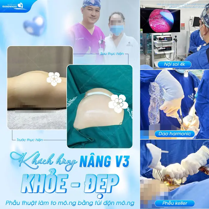 Khách hàng nâng vòng 3 nhẹ nhàng và khỏe đẹp với sự hỗ trợ của công nghệ nội soi 4K hiện đại